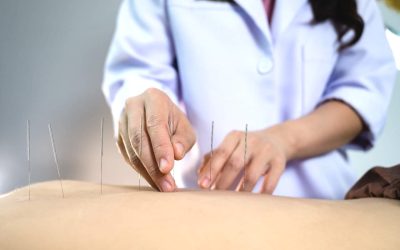 acupuntura
